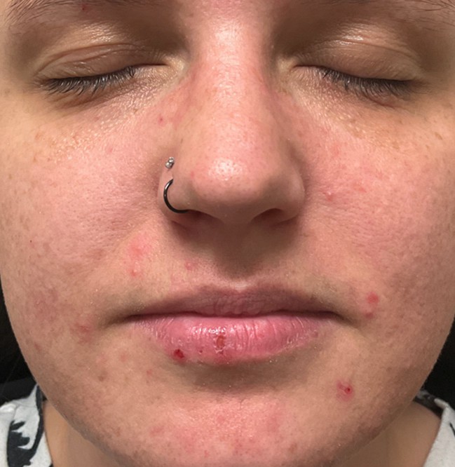 Klar Acne Serum — Baseline