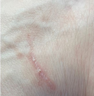 Wound Healing Gel — After 48 hours