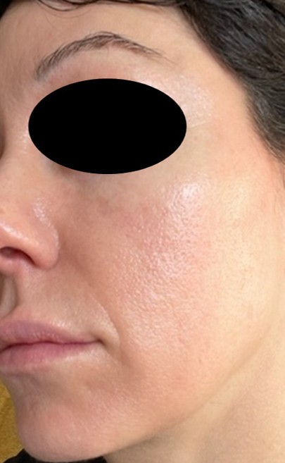 Phyto-Soothe Serum — After 4 days